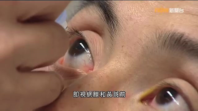【杏林在線】朱東恆醫生 - 眼睛檢查防眼疾
